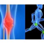 CONOZCA LOS SÍNTOMAS DE LA ARTROSIS Y CÓMO PREVENIRLA